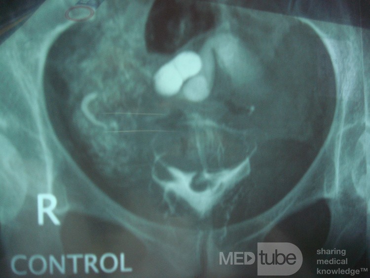 Hidrocele de la trompa de Falopio visto en la HSG