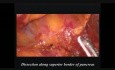 Resección pancreática subtotal laparoscópica por un tumor mucoso quístico