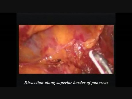 Resección pancreática subtotal laparoscópica por un tumor mucoso quístico
