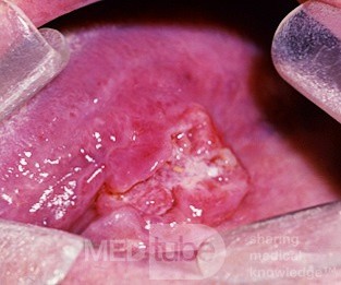 Carcinoma sublingual de células escamosas