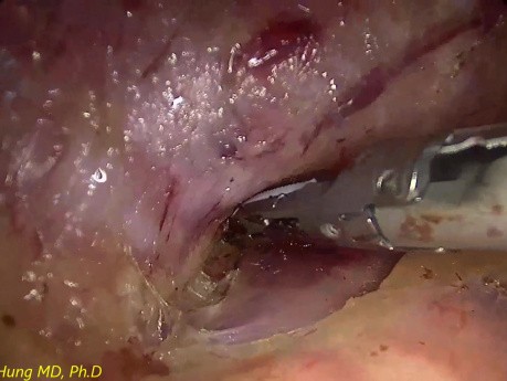 ¿Cómo se disecciona el duodeno?