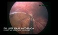 Pneumtosis Quística Intestinal como diagnóstico diferencial de abdomen agudo