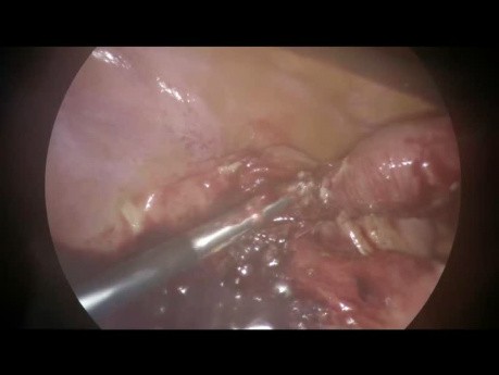 Tratamiento laparoscópico del absceso apendicular