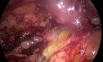 Cirugía laparoscópica retroperitoneal para la extracción de cálculos en la pelvis renal