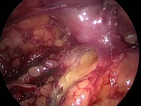 Cirugía laparoscópica retroperitoneal para la extracción de cálculos en la pelvis renal