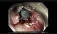 Colonoscopia - RME de una lesión plana en un paciente que toma antitrombóticos