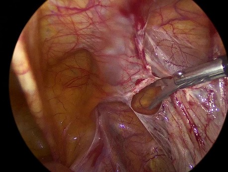 TAPP con pérdida del colgajo peritoneal