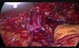 Nefrectomía Transvaginal Laparoscópica De Donante