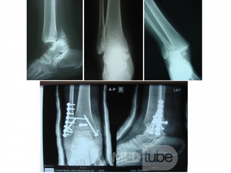 Fractura trimaleolar de tobillo