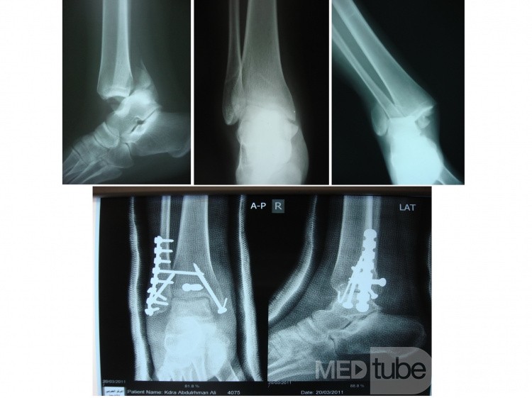 Fractura trimaleolar de tobillo