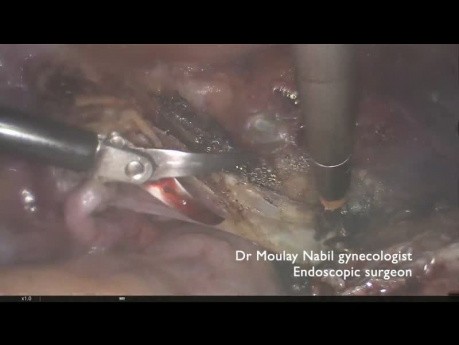 Histerectomía total después de miomectomía abierta