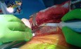 Extracción de la arteria mamaria interna izquierda esqueletizada con bisturí armónico