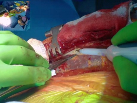 Extracción de la arteria mamaria interna izquierda esqueletizada con bisturí armónico