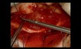 Tumor intraespinal