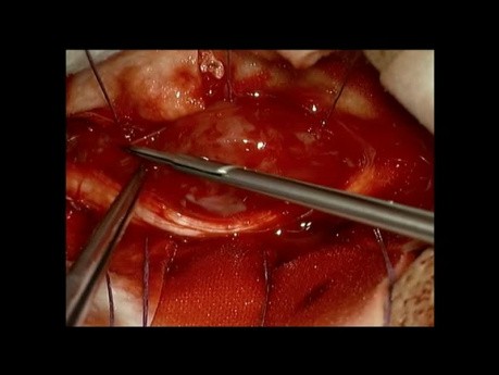 Tumor intraespinal