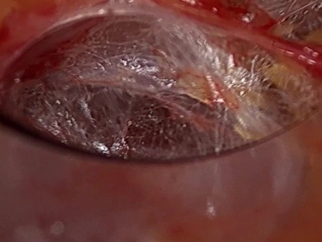 Cirugía endoscópica de tiroides transsubclavia de doble puerto