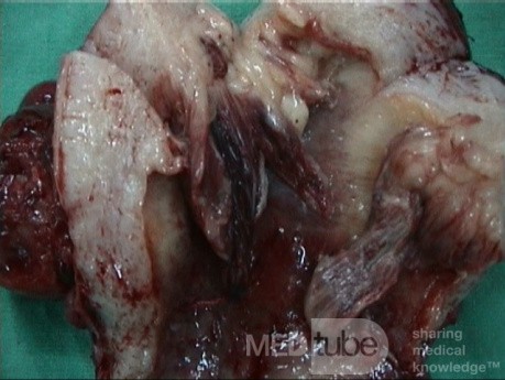 Sarcoma uterino