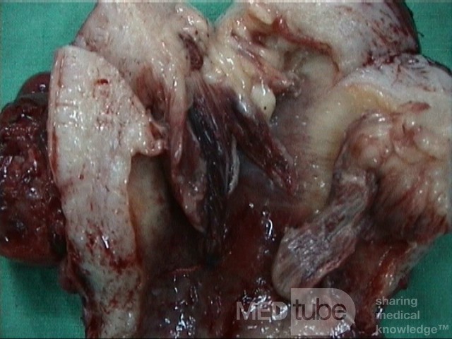 Sarcoma uterino