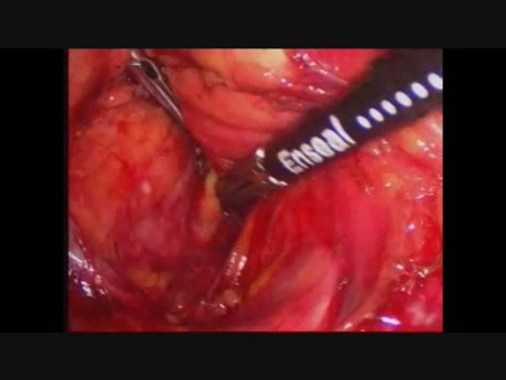 Resección periférica de páncreas por vía laparoscópica, debido a un tumor neuroendocrino