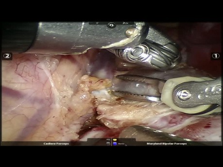 Secuestro pulmonar extralobar