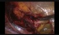 Reparación laparoscópica TAPP de hernia inguinal directa estrangulada en paciente femenina