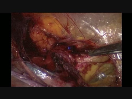 Reparación laparoscópica TAPP de hernia inguinal directa estrangulada en paciente femenina