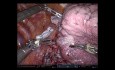 Segmentectomía robótica del lóbulo superior derecho S2