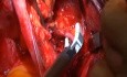 Histerectomía radical, resección del ligamento cardinal (parametría lateral)