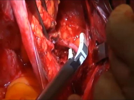 Histerectomía radical, resección del ligamento cardinal (parametría lateral)