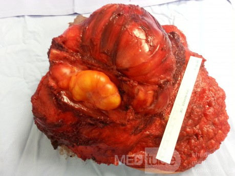 Liposarcoma de la mama izquierda que invade el espacio intercostal subyacente - margen posterior