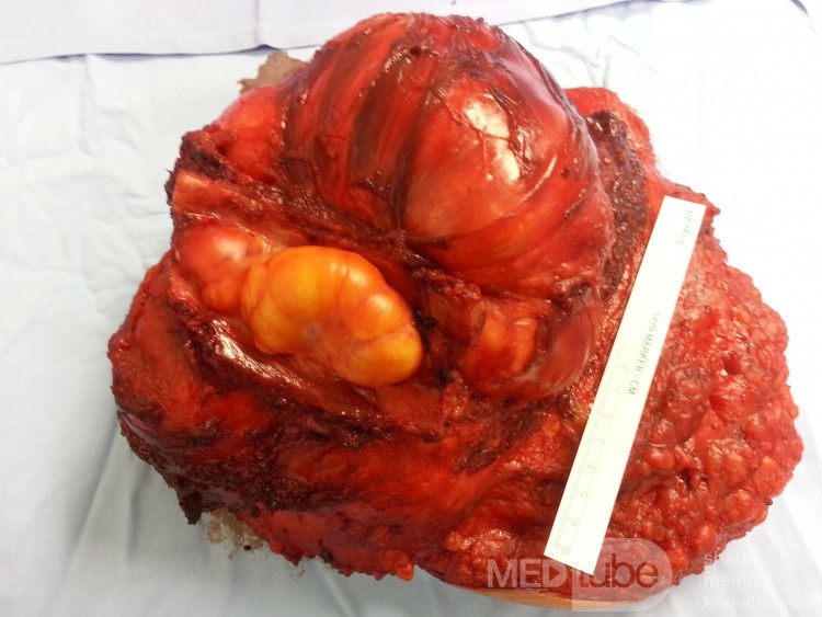 Liposarcoma de la mama izquierda que invade el espacio intercostal subyacente - margen posterior