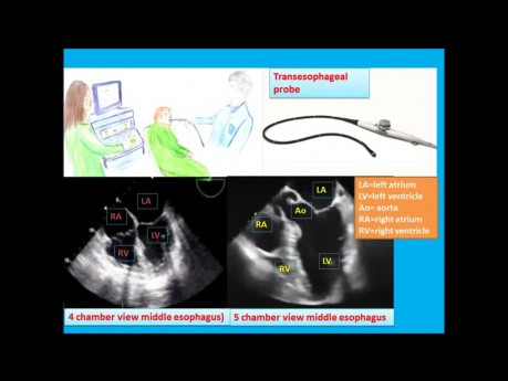 Un sencillo test de ecocardiografía transesofágica e introducción a las vistas de la ETE