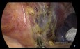 Gastrectomía total laparoscópica, D2 LND + PIPAC
