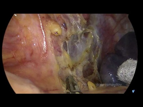 Gastrectomía total laparoscópica, D2 LND + PIPAC