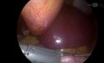 Gastrectomía en manga laparoscópica