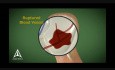 Accidente cerebrovascular - Animación médica en 3D