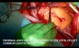 Aneurisma de aorta ascendente que afecta al arco de aorta proximal