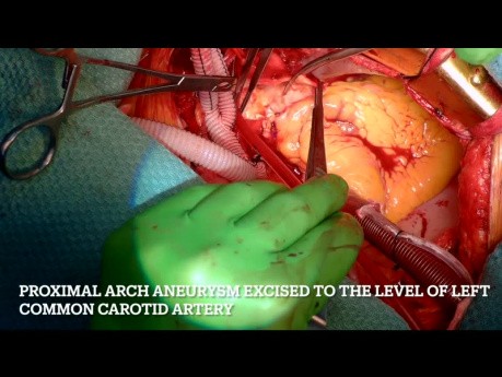 Aneurisma de aorta ascendente que afecta al arco de aorta proximal