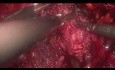 Adenomectomía laparoscópica
