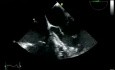 Insuficiencia valvular aórtica grave