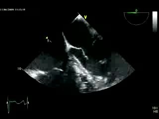 Insuficiencia valvular aórtica grave