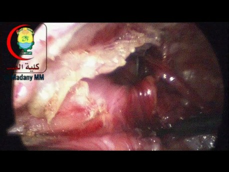 Los instrumentos laparoscópicos de 3 mm son frágiles pero pueden ser preferidos para su uso en bebés