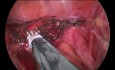 Uso de sutura de anclaje V-lock en laparoscopia