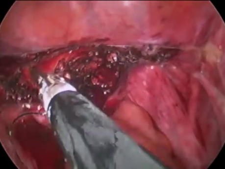 Uso de sutura de anclaje V-lock en laparoscopia
