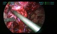 Extirpación laparoscópica de malla erosionada y revisión de la gastroyeyunostomía