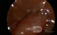 Pólipo visto mediante una histeroscopia