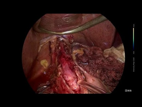Cardiomiotomía laparoscópica de Heller + fundoplicatura DOR