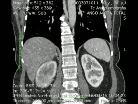 Tromboembolectomía de la vena cava inferior con nefrectomía radical