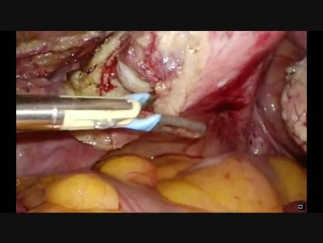 Histerectomía total laparoscópica  