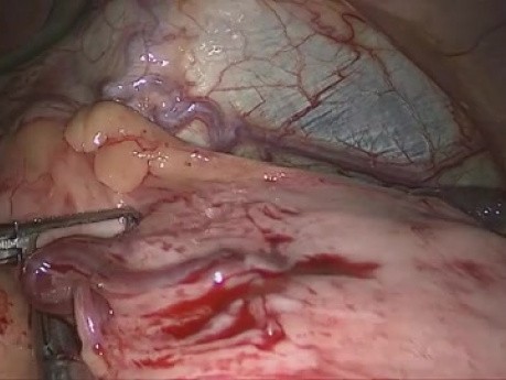 Revisión laparoscópica de la cardiomiotomía de Heller
